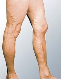 Varicose veins in the legs of a man