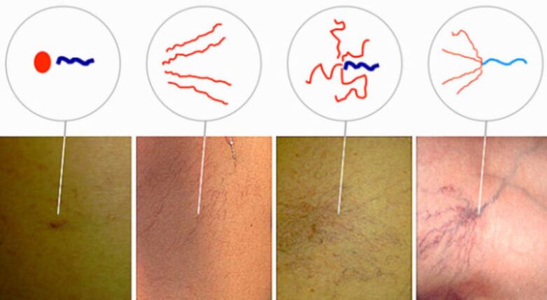 Varicose veins in the initial stage of varicose veins