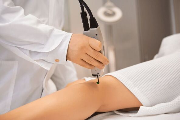 Laser coagulation of the veins of the lower extremities