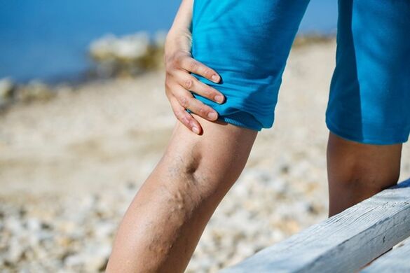 Nagging pain in the legs with varicose veins
