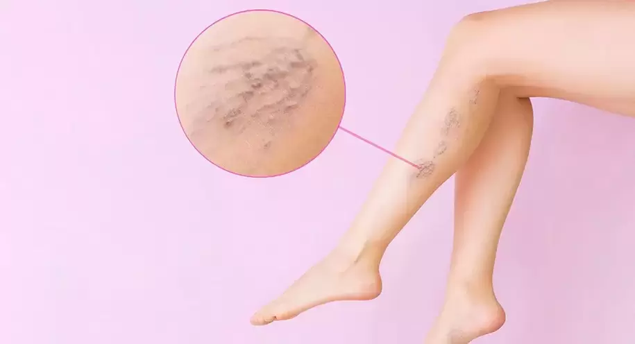 Tortuous bulging veins on legs with varicose veins