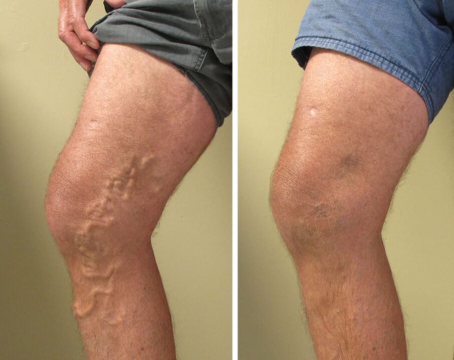 Varicose veins of superficial vessels cannot be ignored