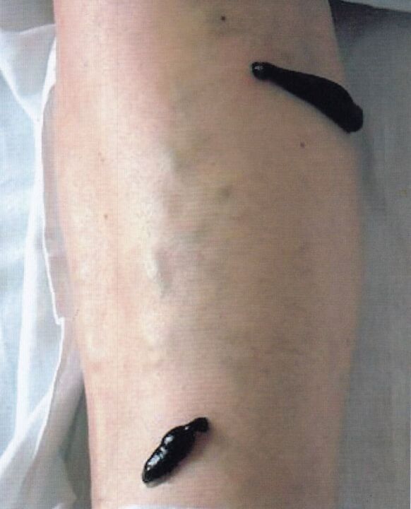 Hirudotherapy - treatment of varicose veins on the legs with leeches